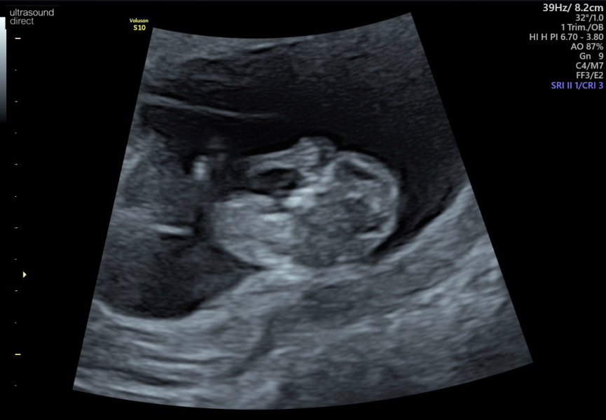 ERA/Alice/Emma infertility thread graduates/pregnancies