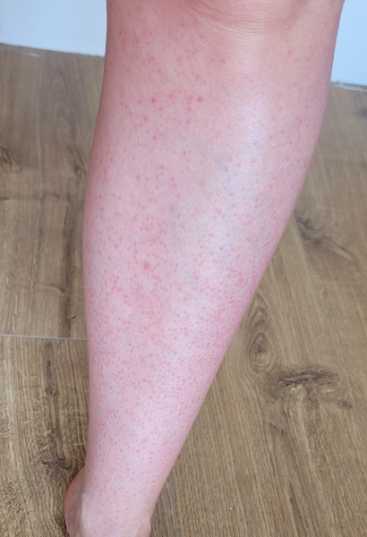 This will go away right? (Pic)