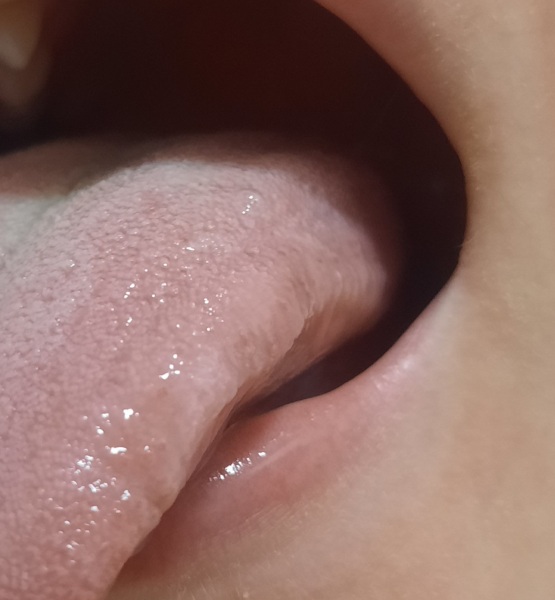 Lump on tongue with  pic