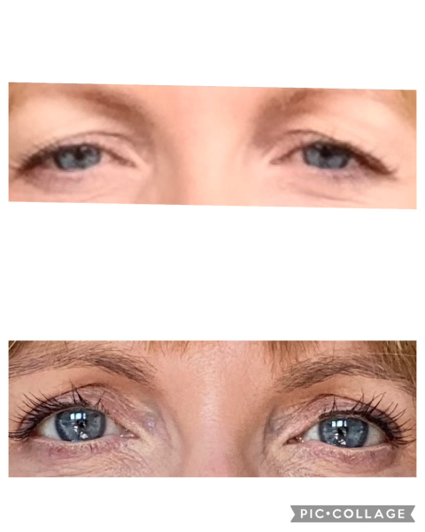 Upper Blepheroplasty