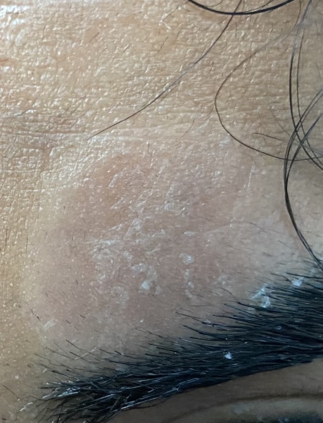 To think this isn’t fungal infection (pic) 