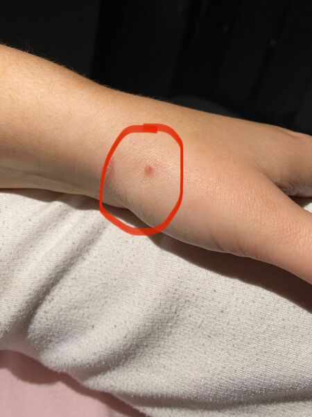 Skin cancer?