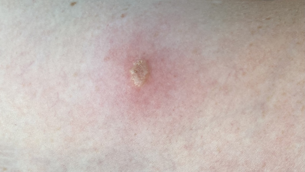 Come and look at my insect bite please!