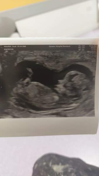 Scared I am going to loss baby, 12 weeks, spotting, cramps