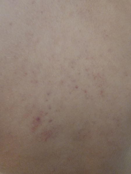 DD 4 rash  (pic)