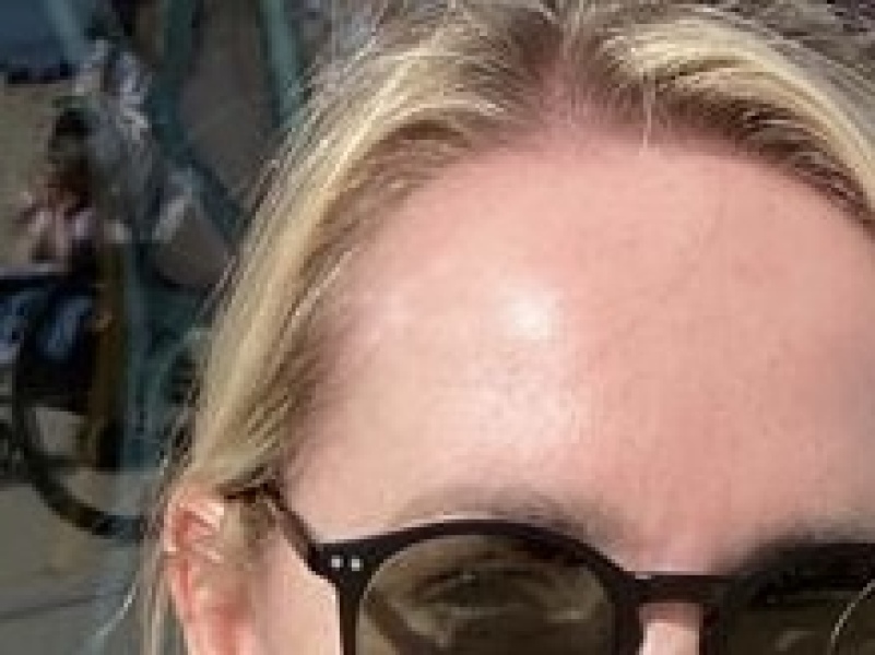 BCC on nose… surgery