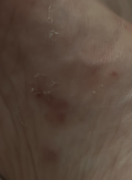 Is this athletes foot? Pic 