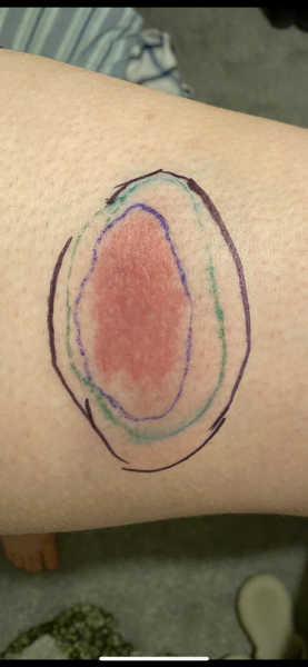 (Maybe?) Nasty bite?