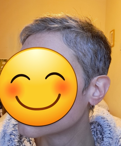 Hair dye allergy and going grey - please help!!