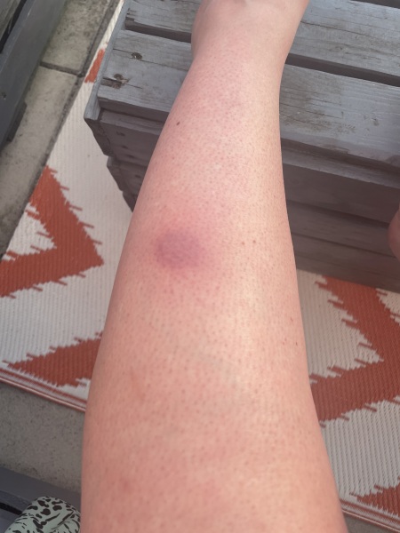 Insect bite - photos 