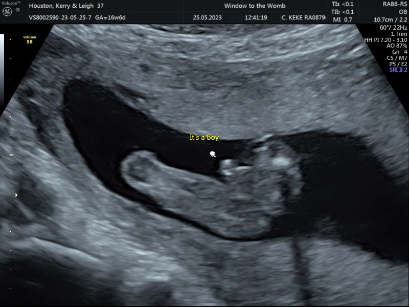 Potty shot 17 weeks