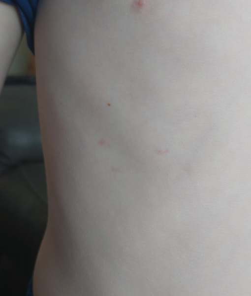 Chickenpox?