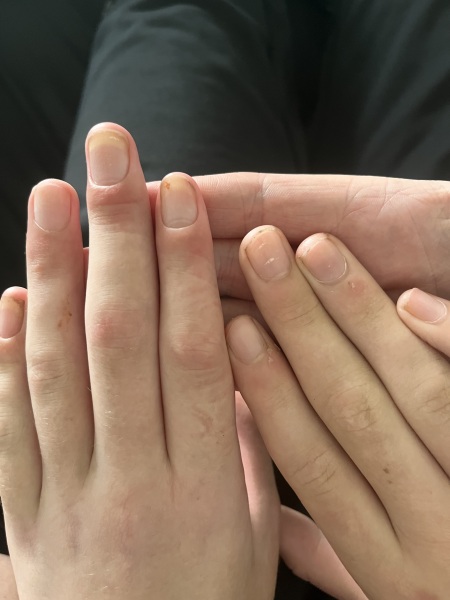 Hand and fingers all weird looking after broken wrist