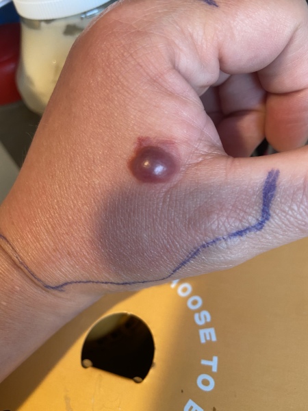 Bite, red/purple blister and swelling/nurses 