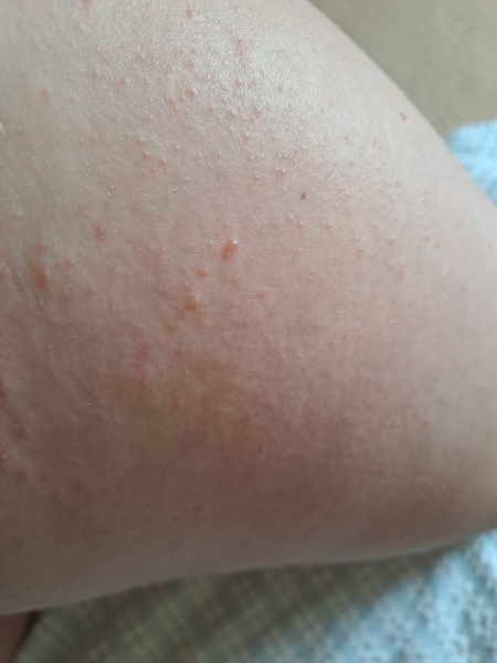 What the heck is this rash?? 