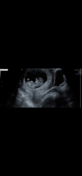 Guess the gender 11 week scan just for fun