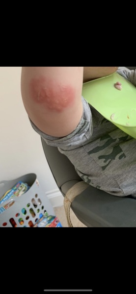 Weird blisters