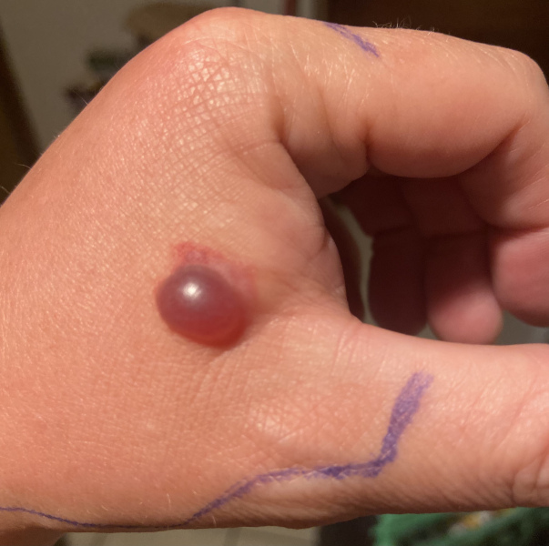 Bite, red/purple blister and swelling/nurses 