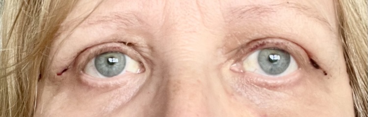 Upper Blepheroplasty