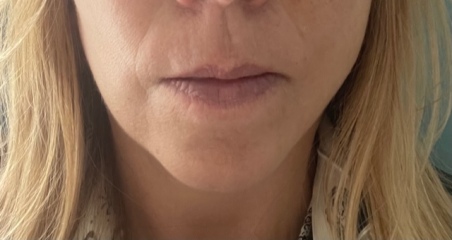 Upper Blepheroplasty