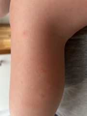  Chickenpox? 