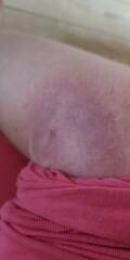 Bite (allergy)