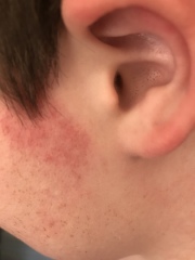 12 year olds skin