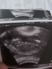 Anyone worried their private gender scan is wrong?