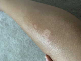 Help, patches on skin not going away pics included