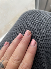 Melanoma scare advice please