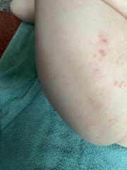 What could this rash be?