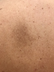 Weird dodgy patch on skin?