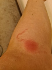 Would you be concerned by this bite?
