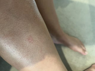 Weird patches on legs (pics)