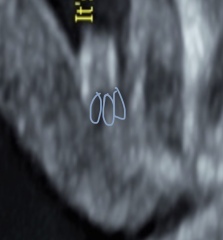 Gender prediction help!! Think my scan has been read wrong! Let me know thoughts!