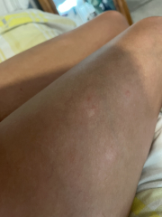 Weird patches on legs (pics)