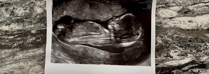 20 week scan on Wednesday, can anyone guess 💙🩷