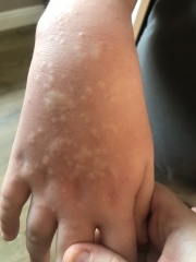 12 year olds skin
