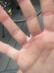 What’s this weird white skin patch between my fingers?