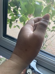 Anyone had an insect bite like this