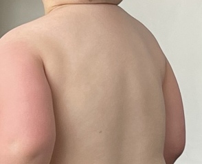 Stubborn rash 