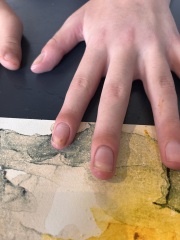 Hand and fingers all weird looking after broken wrist