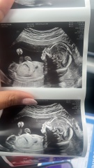 20 week scan gender guess (for fun!)