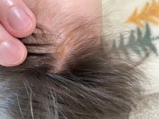 Weird brown mark on 1 year olds scalp. What is it? 