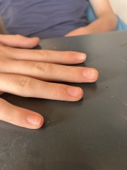 Hand and fingers all weird looking after broken wrist