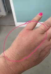 Swollen tingling hand following tiny bite or sting (pics)