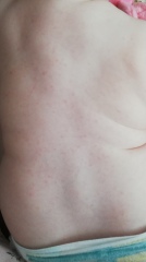 1 Year Old Rash