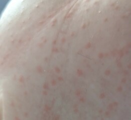 Heat rash?