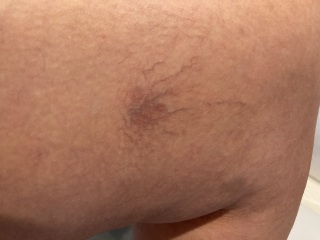 Spider/varicose veins *photos incl*