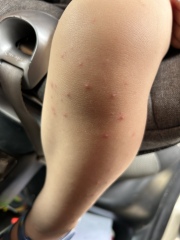 Is this chicken pox or hand foot and mouth?! 